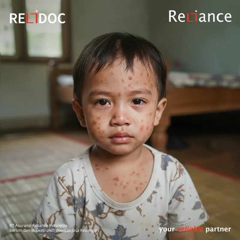 Kenali Tanda-Tanda Awal Campak pada Anak sebelum Terlambat